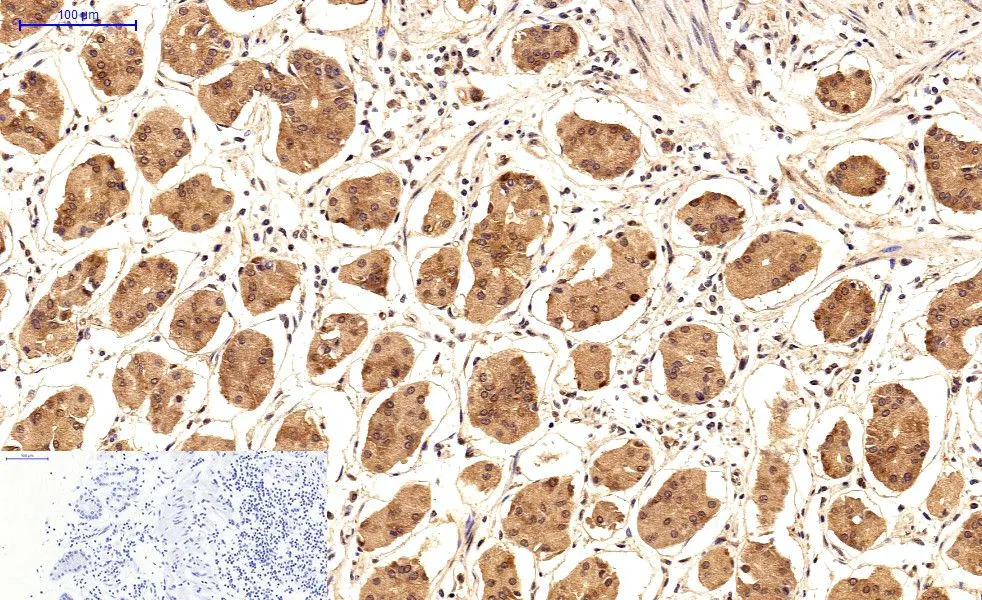 IHC-P analysis of human stomach tissue using GTX34059 Survivin antibody [Mix]. Negative control (the lower left coner) was secondary antibody only. Antigen retrieval : Sodium citrate pH6.0 was used for antibody retrieval (>98oC, 20min) Dilution : 1:200