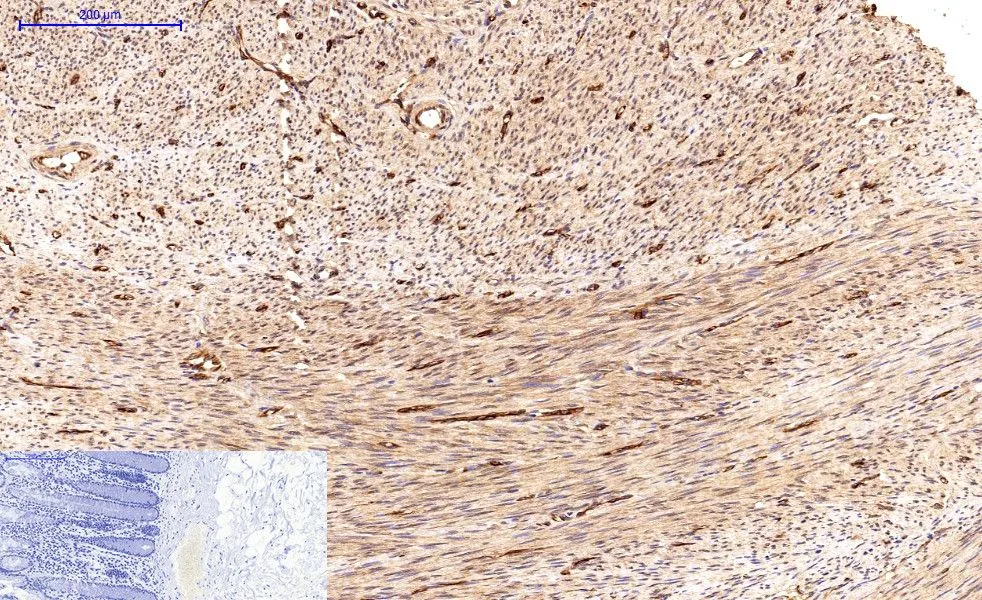 IHC-P analysis of human colon cancer tissue using GTX34059 Survivin antibody [Mix]. Negative control (the lower left coner) was secondary antibody only. Antigen retrieval : Sodium citrate pH6.0 was used for antibody retrieval (>98oC, 20min) Dilution : 1:200