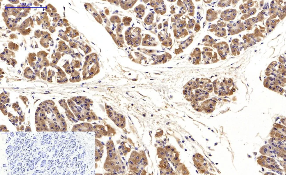 IHC-P analysis of human stomach cancer tissue using GTX34067 LC3A antibody [5G10]. Negative control (the lower left coner) was secondary antibody only. Antigen retrieval : Sodium citrate pH6.0 was used for antibody retrieval (>98oC, 20min) Dilution : 1:200