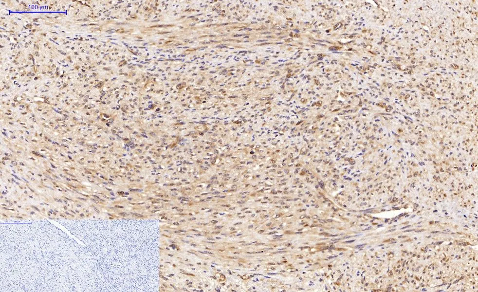 IHC-P analysis of human uterus cancer tissue using GTX34067 LC3A antibody [5G10]. Negative control (the lower left coner) was secondary antibody only. Antigen retrieval : Sodium citrate pH6.0 was used for antibody retrieval (>98oC, 20min) Dilution : 1:200