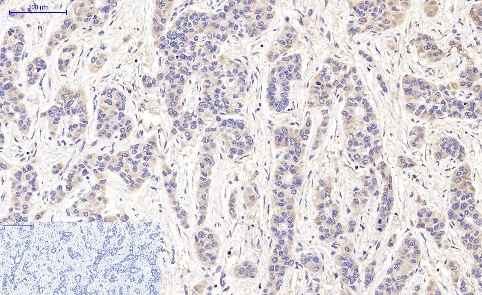 IHC-P analysis of human liver cancer tissue using GTX34067 LC3A antibody [5G10]. Negative control (the lower left coner) was secondary antibody only. Antigen retrieval : Sodium citrate pH6.0 was used for antibody retrieval (>98oC, 20min) Dilution : 1:200