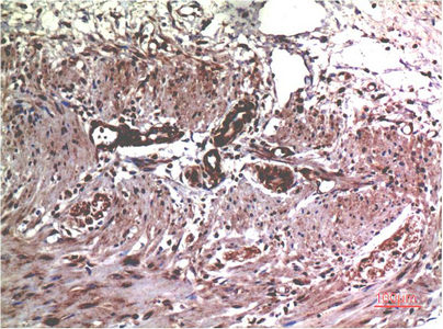 IHC-P analysis of human colon carcinoma tissue using GTX34081 MMP2 antibody [1H1]. Dilution : 1:200