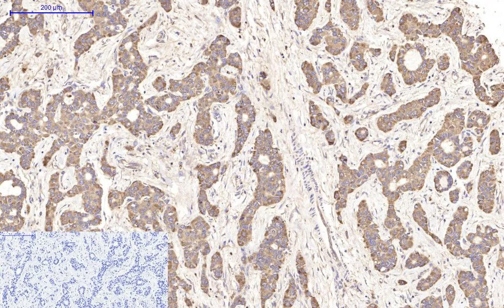 IHC-P analysis of human liver cancer tissue using GTX34098 IKB beta antibody [1F3]. Negative control (the lower left coner) was secondary antibody only. Antigen retrieval : Sodium citrate pH6.0 was used for antibody retrieval (>98oC, 20min) Dilution : 1:200