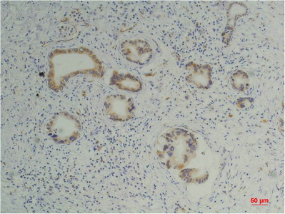 IHC-P analysis of human pancreatic carcinoma tissue using GTX34136 Cyclophilin B antibody [1B3]. Dilution : 1:200
