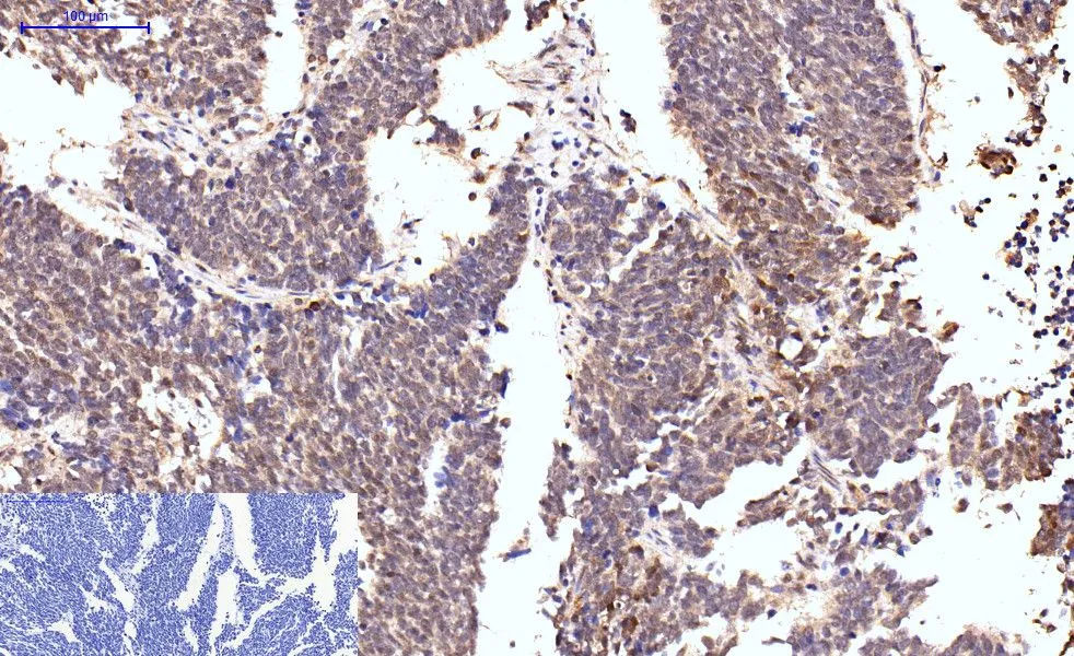 IHC-P analysis of human lung cancer tissue using GTX34167 Caspase 8 antibody [2G12]. Negative control (the lower left coner) was secondary antibody only. Antigen retrieval : Sodium citrate pH6.0 was used for antibody retrieval (>98oC, 20min) Dilution : 1:200