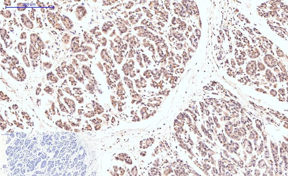 IHC-P analysis of human stomach cancer tissue using GTX34167 Caspase 8 antibody [2G12]. Negative control (the lower left coner) was secondary antibody only. Antigen retrieval : Sodium citrate pH6.0 was used for antibody retrieval (>98oC, 20min) Dilution : 1:200