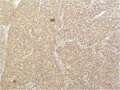 IHC-P analysis of human kidney carcinoma tissue using GTX34195 SGK1 antibody [4D12]. Dilution : 1:200