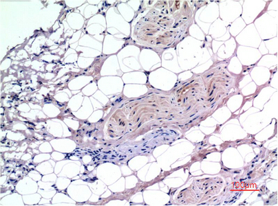 IHC-P analysis of human liver carcinoma tissue using GTX34210 SMAD3 antibody [4C9]. Dilution : 1:200
