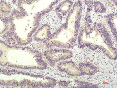 IHC-P analysis of human colon carrcinoma tissue using GTX34233 STAT1 antibody [5H7]. Dilution : 1:200