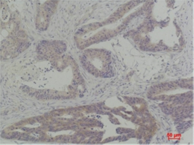 IHC-P analysis of human breast carcinoma tissue using GTX34252 TBP antibody. Dilution : 1:200 IHC-P analysis of human breast carcinoma tissue using GTX34252 TBP antibody. Dilution : 1:200