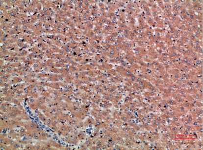 IHC-P analysis of human liver cancer tissue using GTX34306 Chordin antibody. Dilution : 1:200 IHC-P analysis of human liver cancer tissue using GTX34306 Chordin antibody. Dilution : 1:200