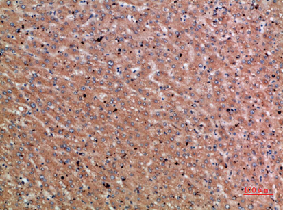 IHC-P analysis of human liver cancer tissue using GTX34306 Chordin antibody. Dilution : 1:200