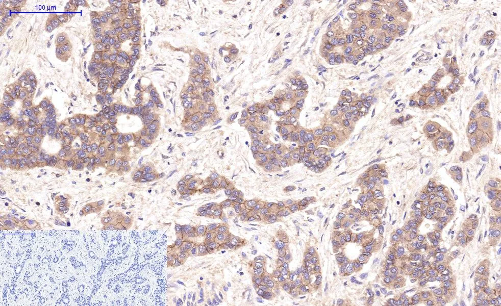 IHC-P analysis of human liver cancer tissue using GTX34339 beta Catenin antibody [4F2]. Negative control (the lower left coner) was secondary antibody only. Antigen retrieval : Sodium citrate pH6.0 was used for antibody retrieval (>98oC, 20min) Dilution : 1:200