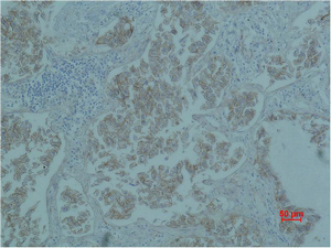IHC-P analysis of human lung carcinoma tissue using GTX34339 beta Catenin antibody [4F2].