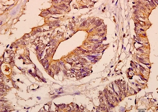 Immunohistochemistry (IHC) analyzes of c-Fms pAb in paraffin-embedded human colorectal carcinoma tissue at 1:50.