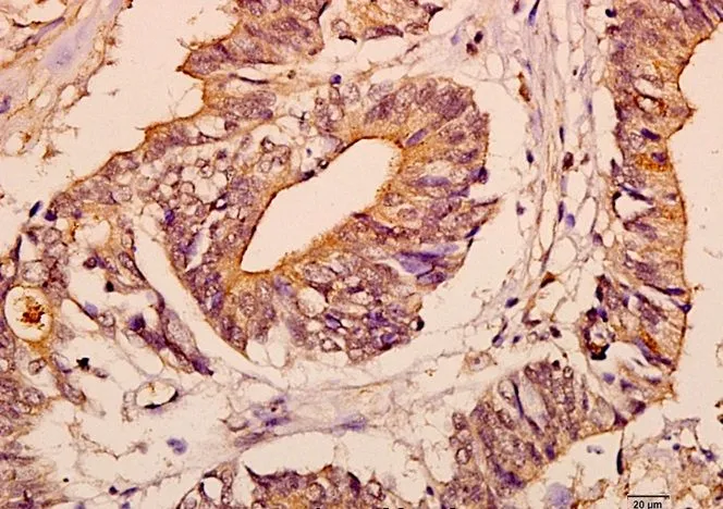 Immunohistochemistry (IHC) analyzes of c-Fms pAb in paraffin-embedded human colorectal carcinoma tissue at 1:50. Immunohistochemistry (IHC) analyzes of c-Fms pAb in paraffin-embedded human colorectal carcinoma tissue at 1:50.