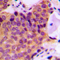 IHC-P analysis of formalin fixed human breast cancer tissue section using GTX34387 JNK (phospho Thr183) antibody. Antigen retrieval : Heat mediated antigen retrieval with sodium citrate buffer (pH 6.0)