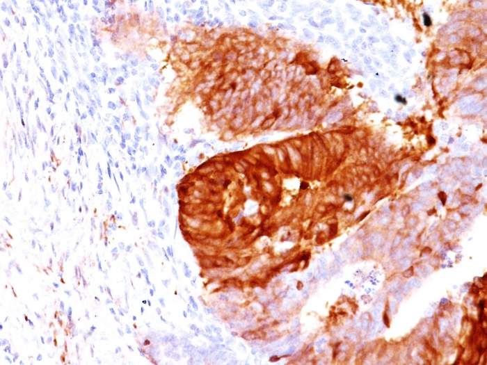 IHC-P analysis of human colon carcinoma tissue using GTX34400 ALDH1A1 antibody [ALDH1A1/1381].