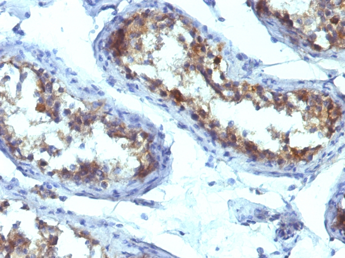 Formalin-fixed,paraffin-embedded human Testicular Carcinoma stained with Alkaline Phosphatase Mouse Monoclonal Antibody (ALPL/597).