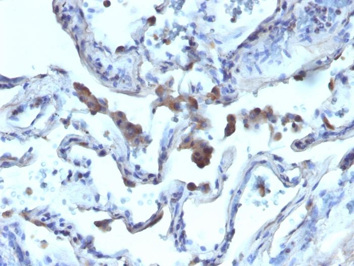IHC-P analysis of human lung carcinoma tissue using GTX34409 AMACR antibody.