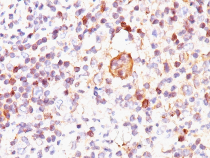IHC-P analysis of human Hodgkins lymphoma tissue using GTX34422 Bax antibody [2D2].