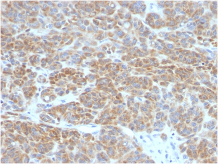 IHC-P analysis of human melanoma tissue using GTX34429 Bcl-2 antibody [BCL2/782].