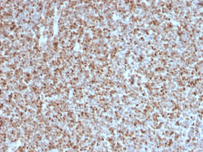 IHC-P analysis of human follicular lymphoma tissue using GTX34434 BCL6 antibody [BCL6/1527].
