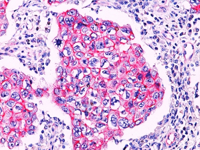 IHC-P analysis of breast ductal carcinoma tissue using GTX34438 beta Catenin antibody.