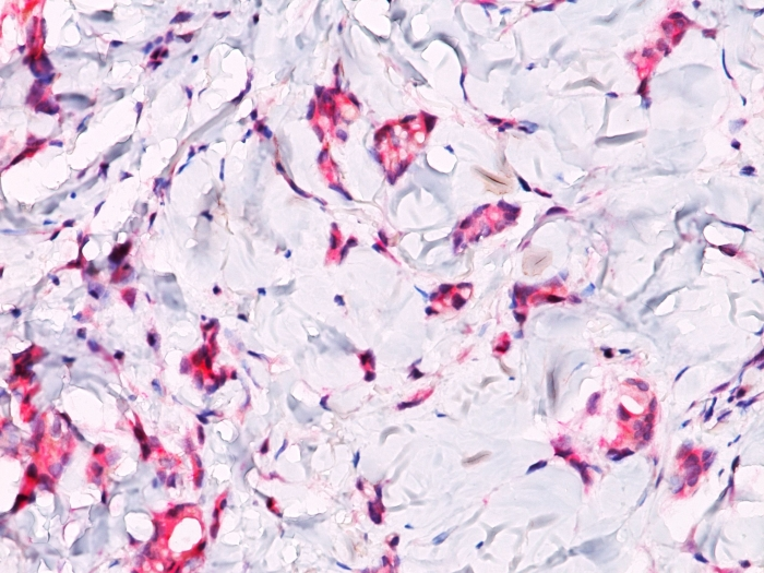 IHC-P analysis of breast lobular carcinoma tissue using GTX34438 beta Catenin antibody.