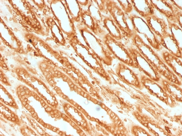 IHC-P analysis of human renal cell carcinoma tissue using GTX34446 Calnexin antibody [CANX/1541].