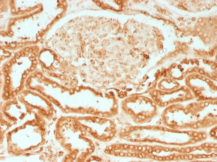 IHC-P analysis of human renal cell carcinoma tissue using GTX34446 Calnexin antibody [CANX/1541].