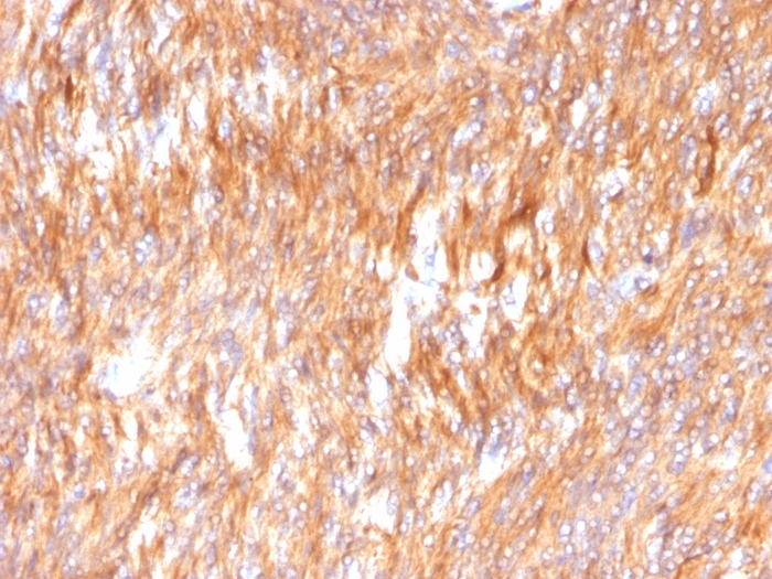 IHC-P analysis of human small intestinal carcinoma tissue using GTX34446 Calnexin antibody [CANX/1541].
