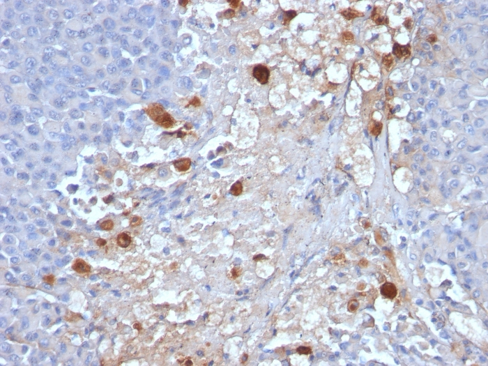 IHC-P analysis of human melanoma tissue using GTX34458 CD146 antibody [MCAM/1101].