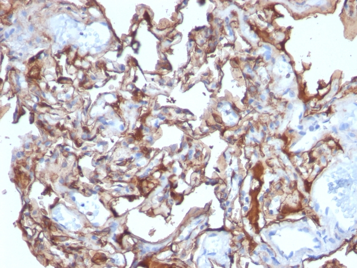 IHC-P analysis of human melanoma tissue using GTX34458 CD146 antibody [MCAM/1101].