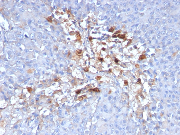 IHC-P analysis of human melanoma tissue using GTX34460 CD146 antibody [C146/634].