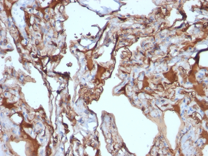 IHC-P analysis of human melanoma tissue using GTX34461 CD146 antibody [MUC18/1130].