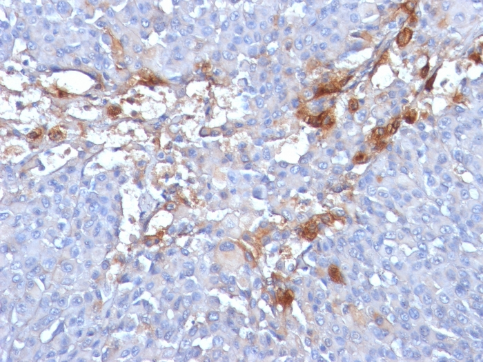 IHC-P analysis of human melanoma tissue using GTX34461 CD146 antibody [MUC18/1130].