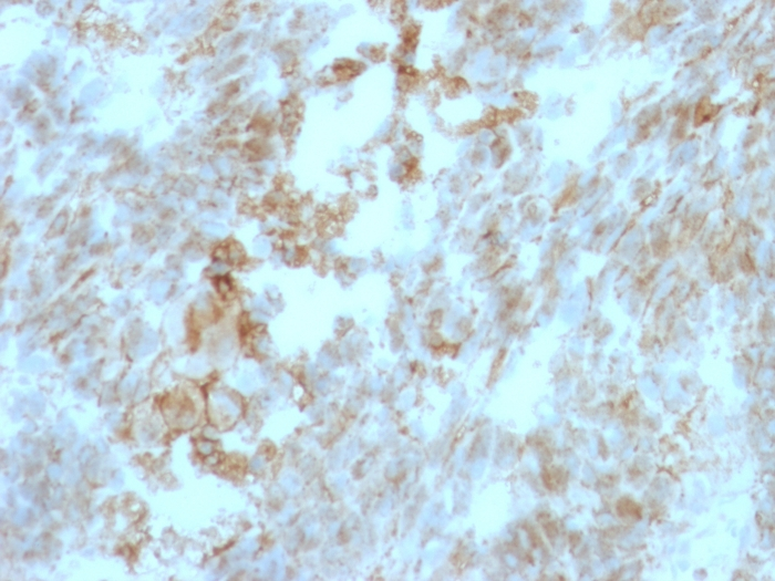 IHC-P analysis of human colon carcinoma tissue using GTX34463 CD147 antibody [BSG/963].