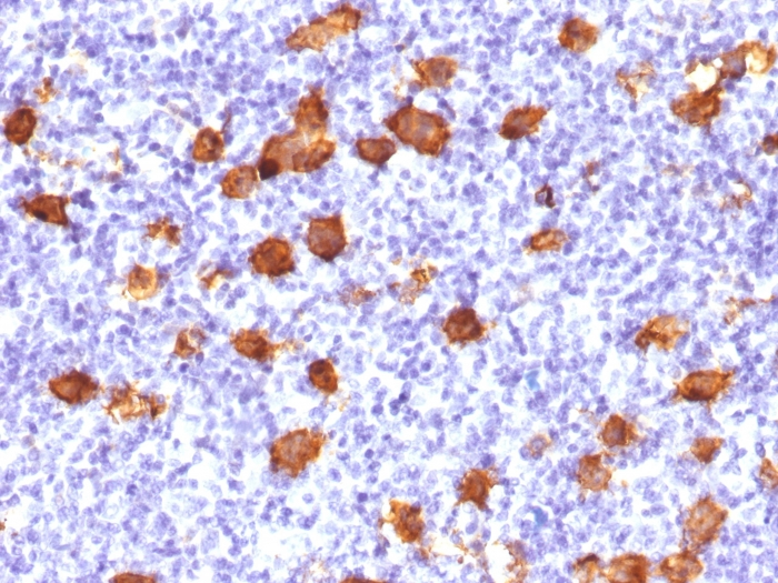 IHC-P analysis of human Hodgkins lymphoma tissue using GTX34482 CD30 antibody. IHC-P analysis of human Hodgkins lymphoma tissue using GTX34482 CD30 antibody.