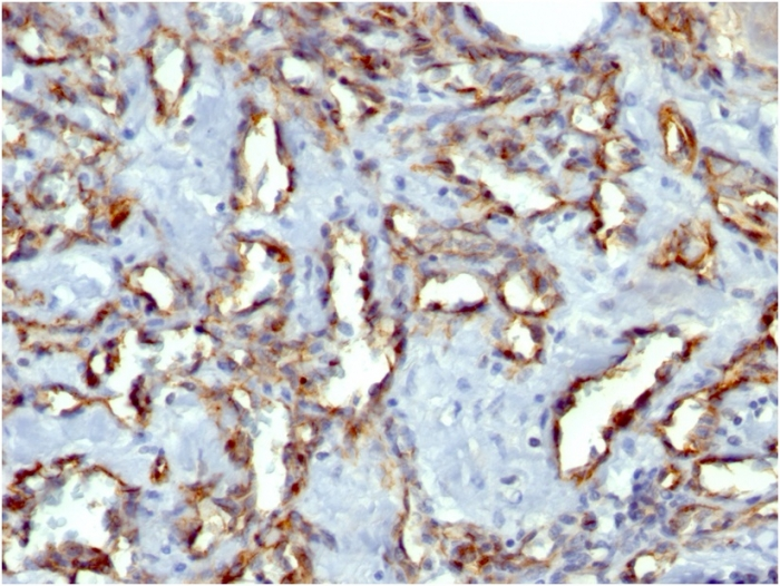 IHC-P analysis of human angiosarcoma tissue using GTX34489 CD31 antibody [C31.7].