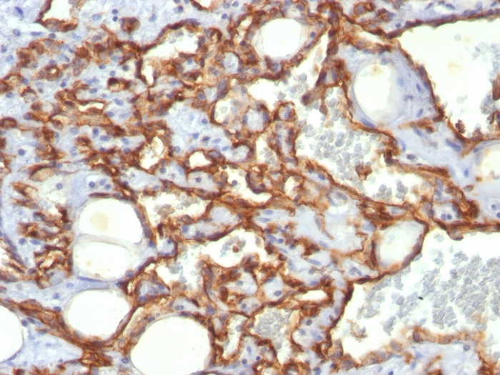 IHC-P analysis of human angiosarcoma tissue using GTX34491 CD31 antibody [SPM532].