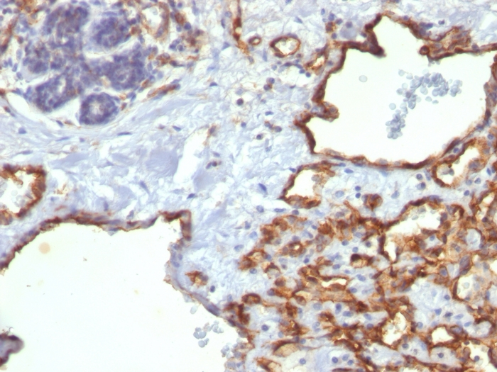 Formalin-fixed,paraffin-embedded human Angiosarcoma stained with CD31 Monoclonal Antibody (SPM122)