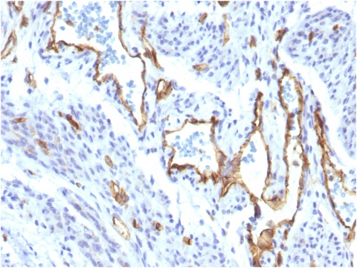 IHC-P analysis of human angiosarcoma tissue using GTX34494 CD31 antibody [C31/1395R].