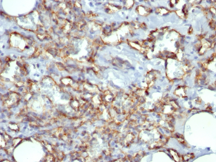 Formalin-fixed,paraffin-embedded human Angiosarcoma stained with CD31 Monoclonal Antibody (JC/70A)