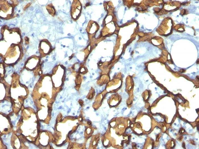 IHC-P analysis of human angiosarcoma tissue using GTX34499 CD34 antibody [HPCA1/763].
