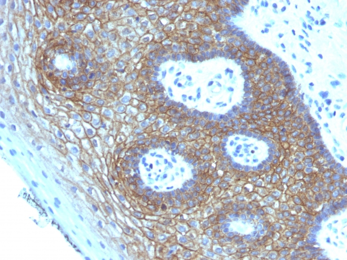 IHC-P analysis of human cervical squamous cell carcinoma tissue using GTX34520 CD44v4 antibody [CD44v4/1219].