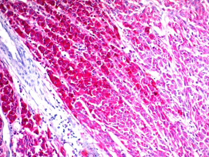 IHC-P analysis of human melanoma tissue using GTX34538 CD63 antibody [NKI/C3].