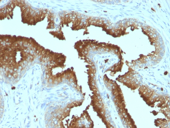 IHC-P analysis of human prostate carcinoma tissue using GTX34540 CD63 antibody [MX-49.129.5].