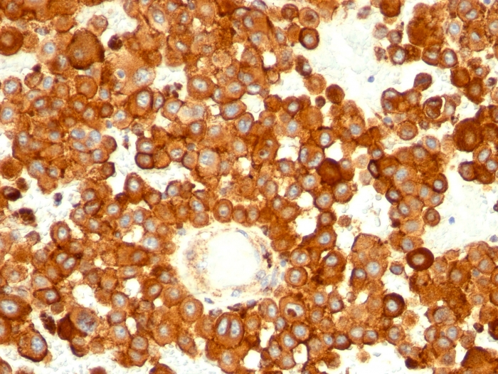 IHC-P analysis of human melanoma tissue using GTX34540 CD63 antibody [MX-49.129.5].