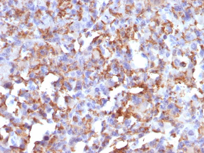 IHC-P analysis of human histiocytoma tissue using GTX34545 CD68 antibody [LAMP4/824].